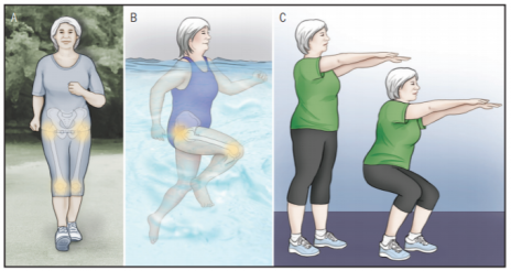 Osteoarthritis and Exercise – physioworks